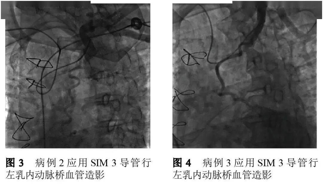 冠状动脉旁路移植术后经右桡动脉入径行左乳内动脉桥血管造影