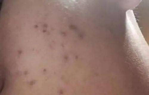 成分|脸上的晒斑、痘印比蛋壳还“脏”......还有救吗？！