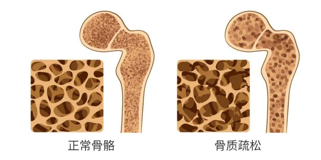 打个喷嚏,骨头就断了?1分钟测出你骨头是不是"嘎嘣脆"