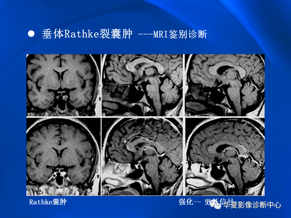 垂体rathke裂囊肿mr表现