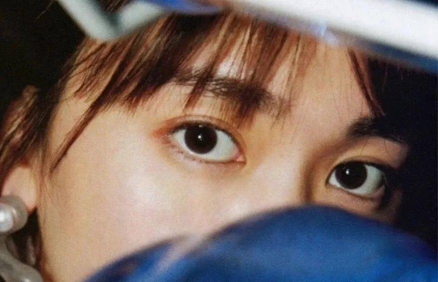 双杠|“悲伤蛙”，双杠眼……双眼皮到底怎么割？！