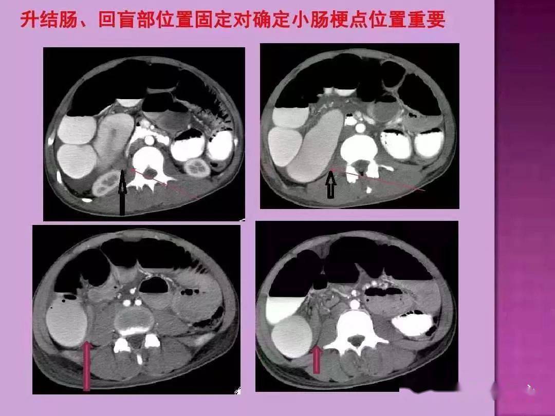 ct上如何寻找肠梗阻的梗阻点