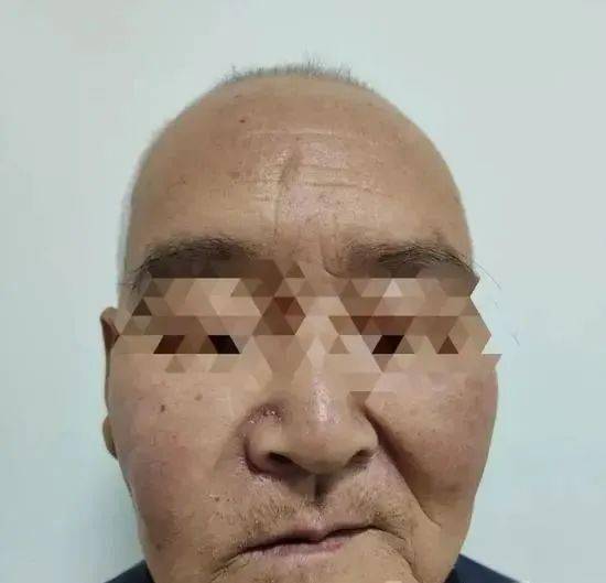 鼻窦里长牙齿,这不仅让老刘面部肿痛,还造成了更为严重的后果.