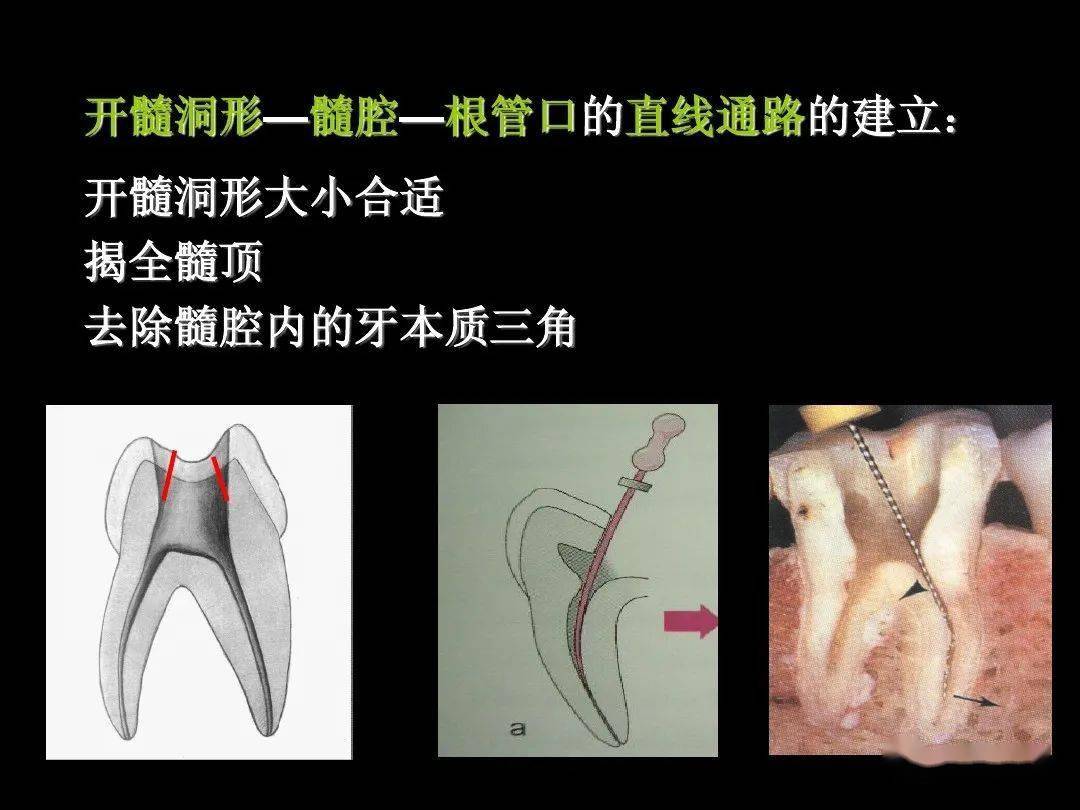 开髓