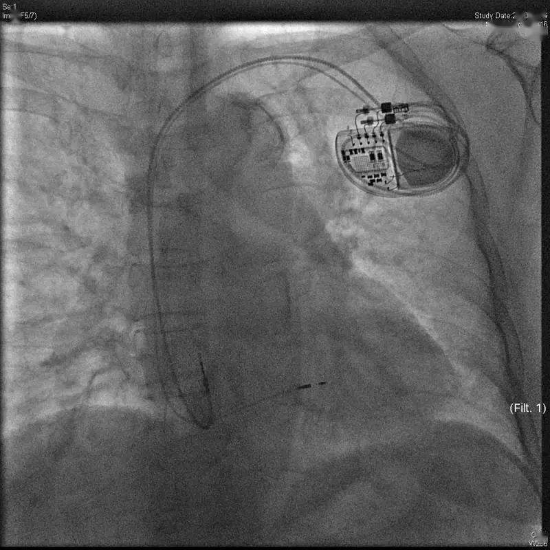 寿命|中国首台！清华长庚心内科植入3.0T核磁兼容长寿命起搏器