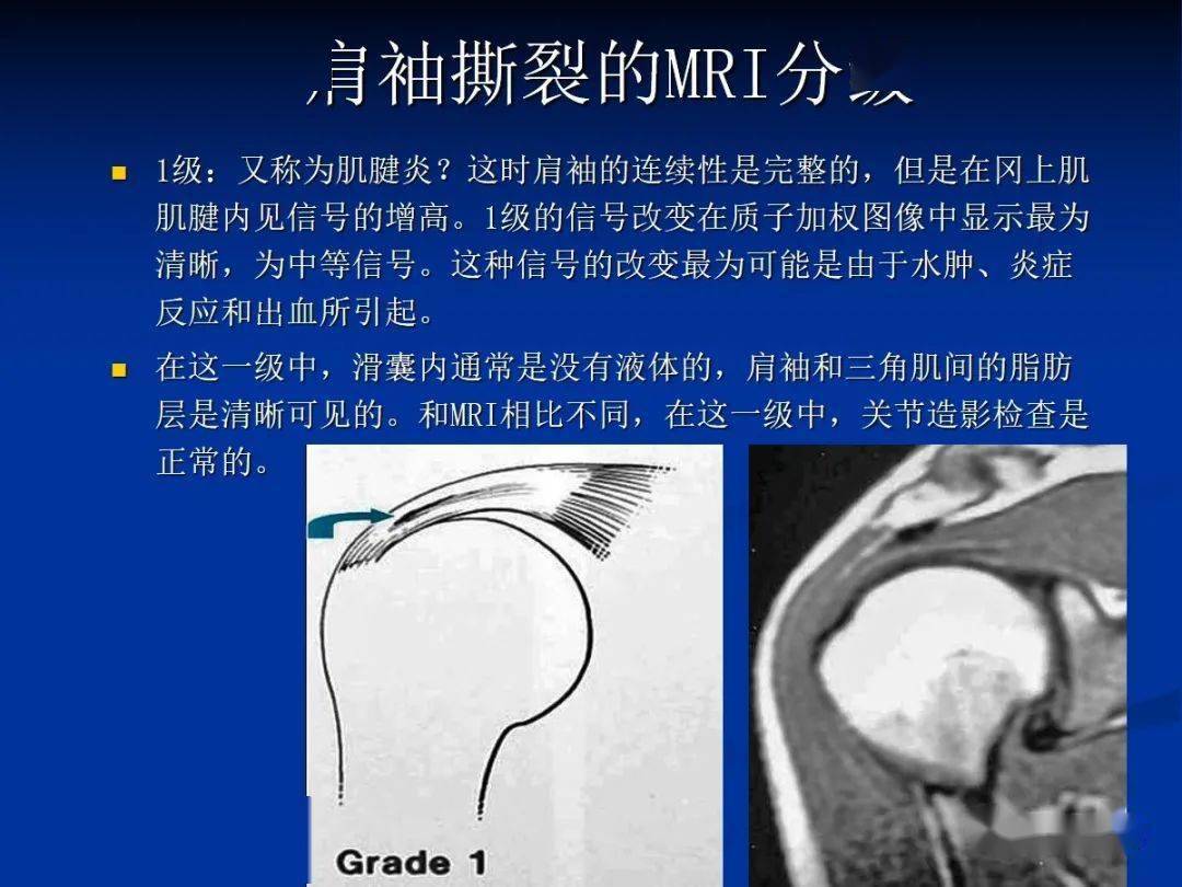 肩袖解剖及损伤的临床及mri诊断