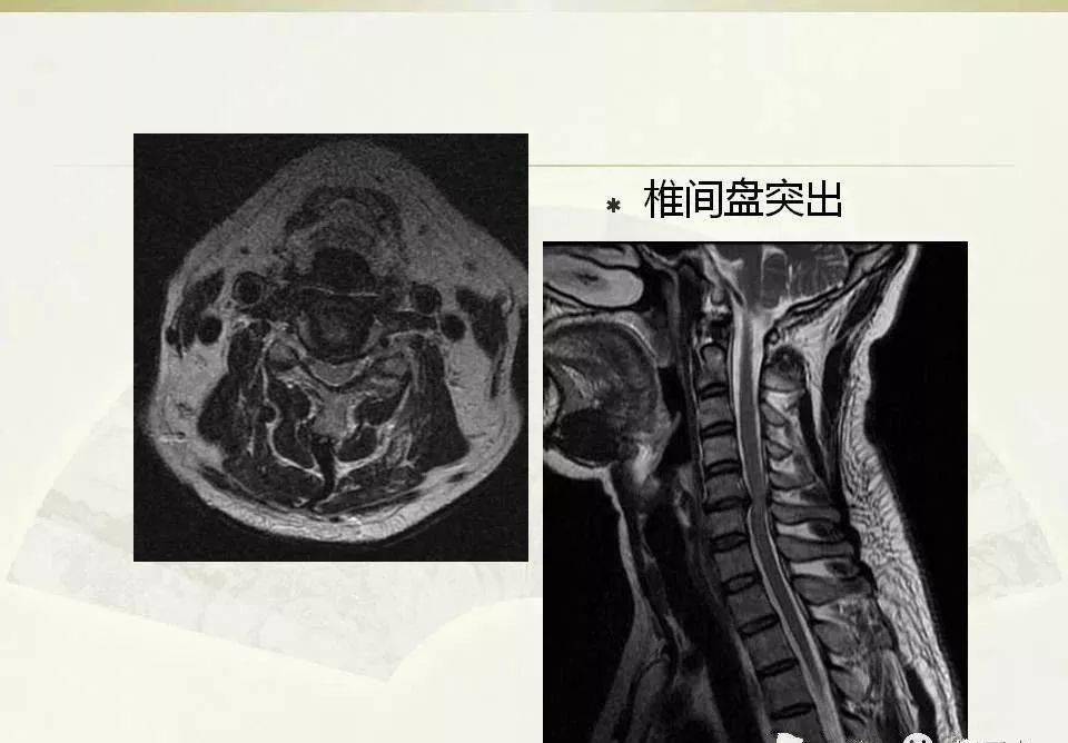 详细颈椎x线解读及关于颈椎病的影像学诊断及分型汇总