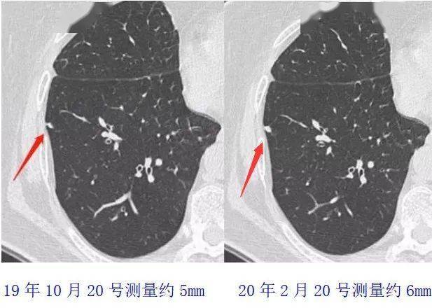 肺部ct孤立性结节是良性还是恶性你get到了