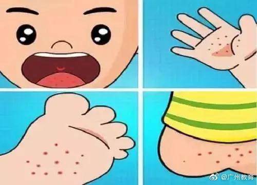 偷袭|秋季要警惕手足口病偷袭！咋防？家长老师快收好这份秘籍