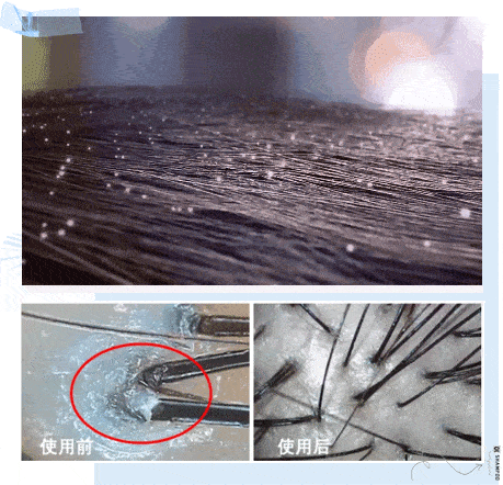 克兰|头上抠下的“白泥”，居然不是头皮屑？脱发头油都是因为它？