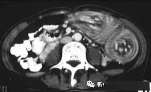 肾破裂7 脾脏破裂6 胰腺破裂5 肝破裂出血4 空腔器官穿孔3 急性胰腺炎