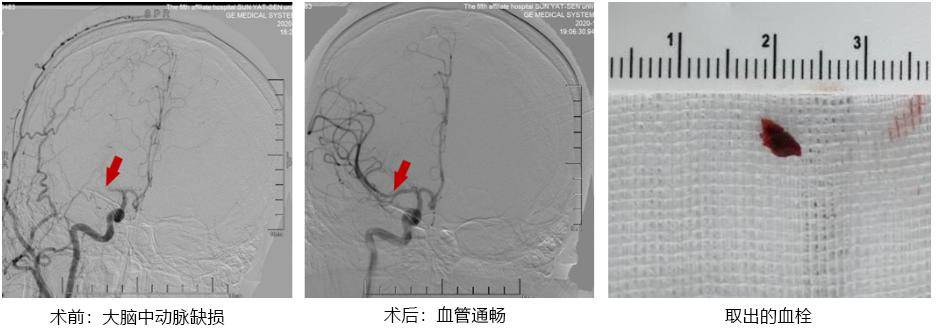 症状|27岁珠海小伙突发脑梗病危！医生：加班熬夜玩手机都是病因