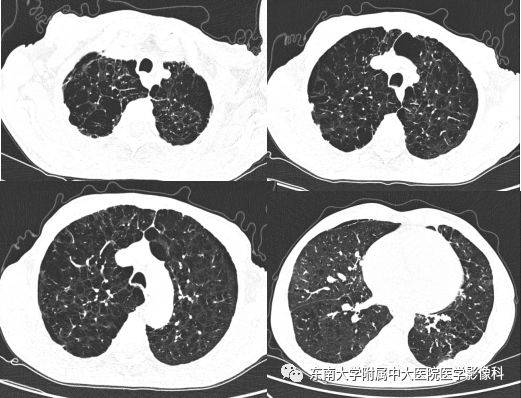 胸部丨肺气肿的ct诊断及相关鉴别诊断