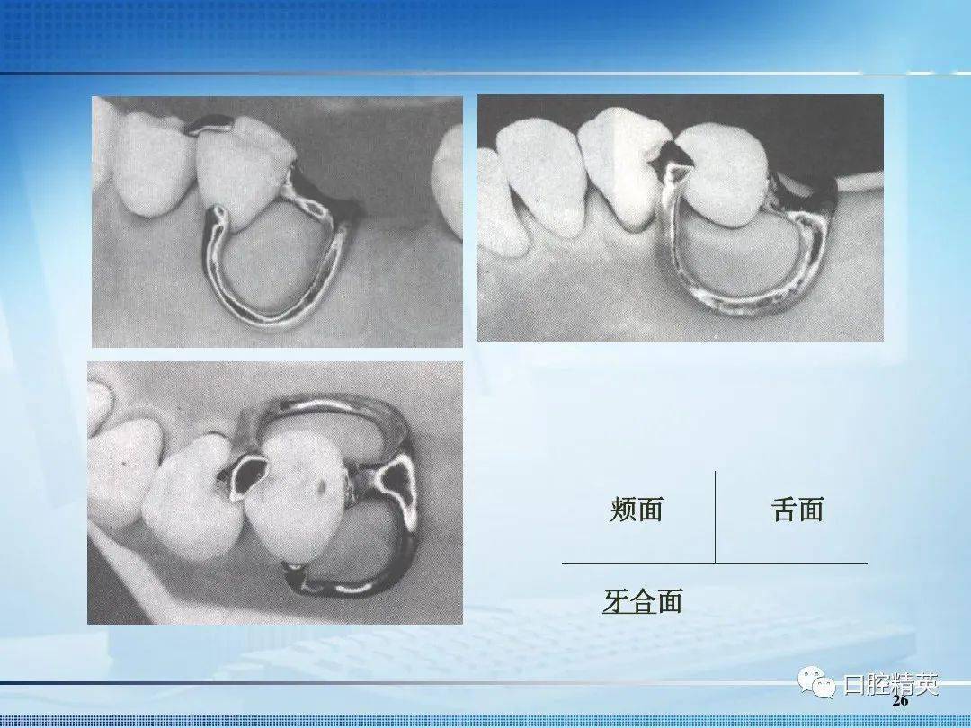 注:文章点赞过50 下期更新《卡环弯制》返回搜狐,查看更多