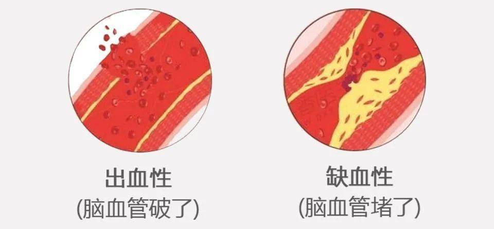 秋冬脑卒中预防你可知