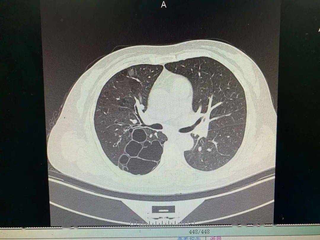 以中下叶为著,部分囊腔内可见气液平;双肺纹理增多,支气管分支管