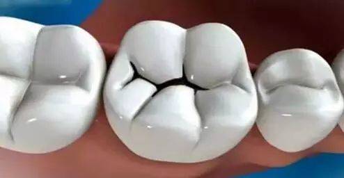然而, 在人们关注牙齿的时候, 一条条出现在白色牙齿间的黑缝引起了