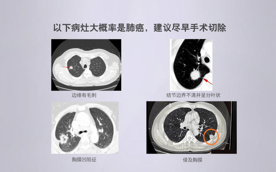 你了解肺结节吗?莫让肺结成"心结"!