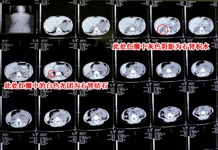 双输尿管结石可以一起做手术吗 3947555aec56400aa8dbc1a77c4663fc.png