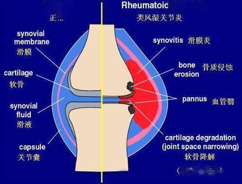 2,重视髌下脂肪垫的治疗  王老师认为膝关节是人体关节中负重最多