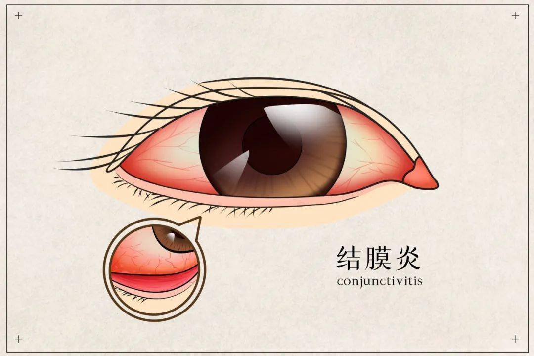 眼分泌物增多,眼睑结膜充血等结膜炎症状,严重的还会导致眼睑皮肤红肿
