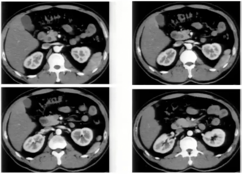 胰腺|看得懂这些腹部CT，主任一定对你刮目相看！