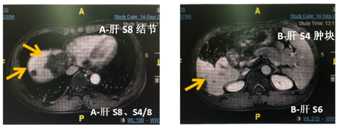 53 ng/ml(正常)影像学评价:2020年9月14日上腹部mri,见肝s8,s6,s4/8