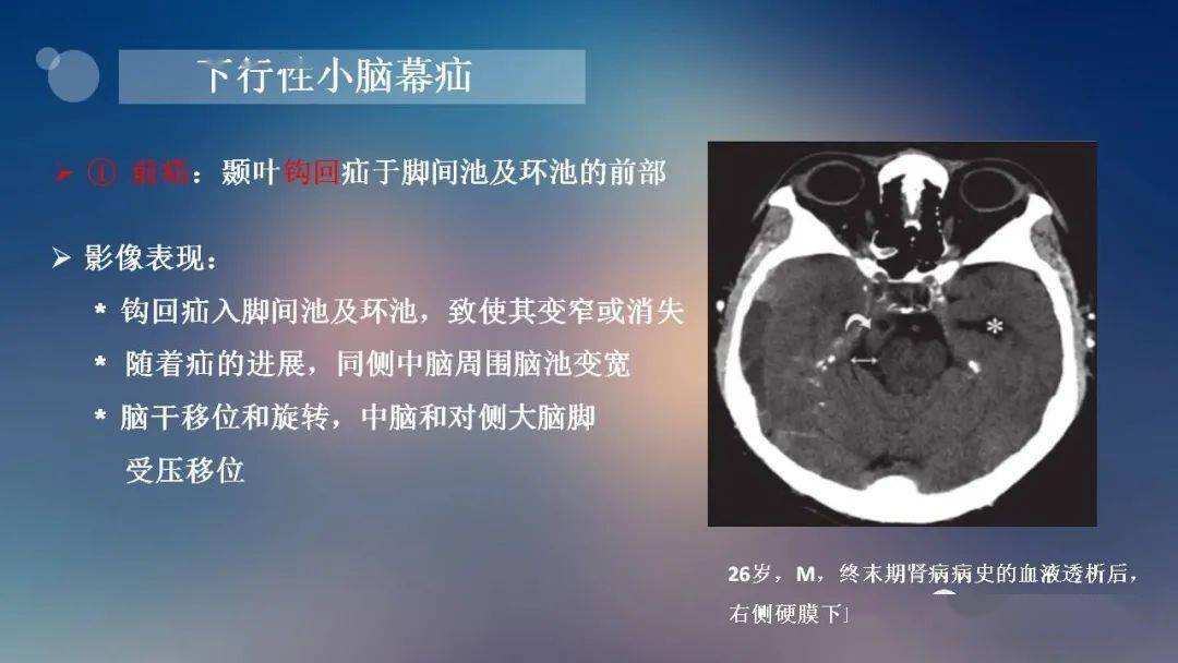 神经必备脑疝的类型及其影像学特征