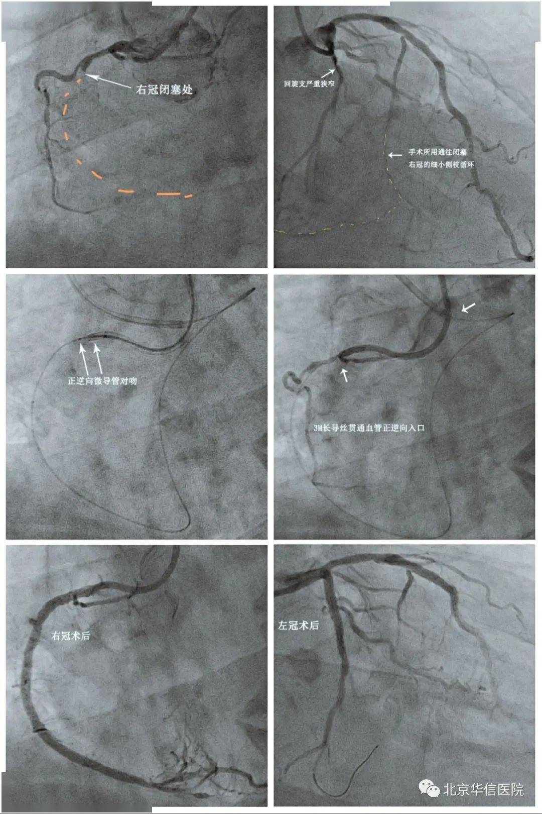 技术反向开通血管,精细,准确地处理回旋支重度狭窄病变后,定向微导管