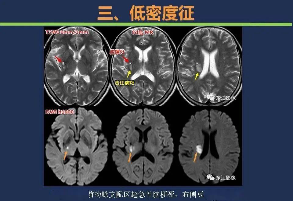 【影像】头颅ct如何预判超早期脑梗死?