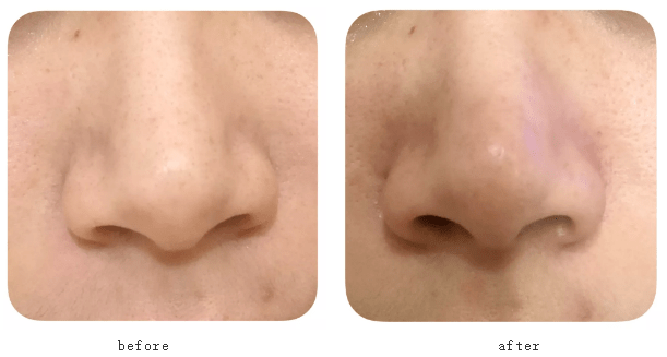 皮肤|一杯奶茶钱就能做的医美，做完立刻后悔！