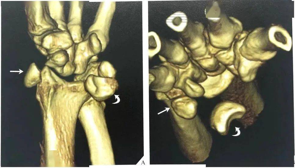 腕关节脱位及其x片阅读技巧