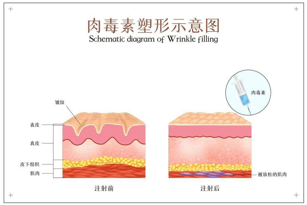 肉毒素祛皱的原理是什么?