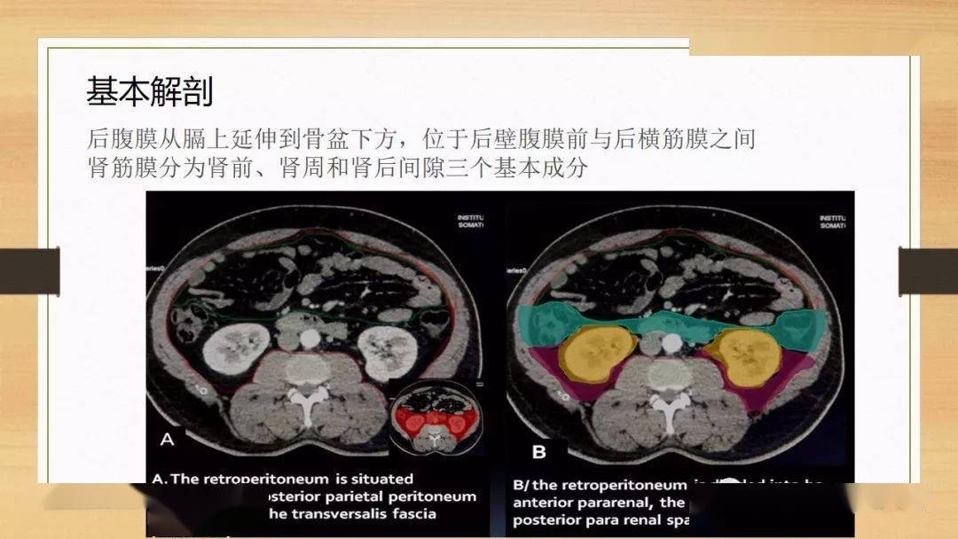 常见原发性腹膜后肿瘤影像诊断及鉴别诊断