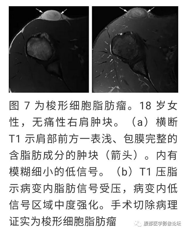 腹膜后丨梭形细胞脂肪瘤