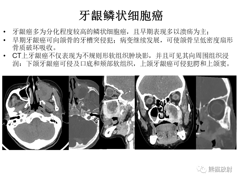 下颌骨鳞状细胞癌,牙龈鳞状细胞癌返回搜狐,查看更多