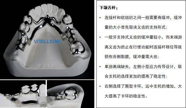 维他灵支架-应力中断的概念与原理