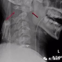 寰椎后弓骨折是c1常见的骨折;常由于过伸位损伤造成