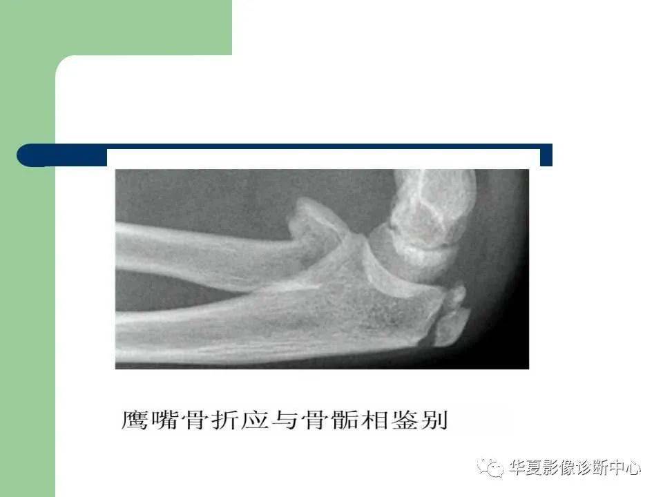 影像基础儿童肘关节损伤x线诊断
