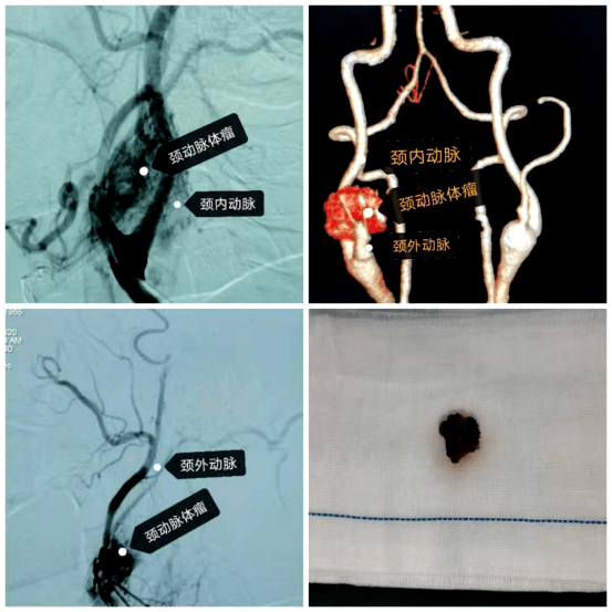 右下图为手术切除的颈动脉体瘤三例高难度手术的开展,成功为患者拆除