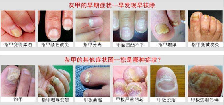 灰指甲治不好?用它就够,轻松重获亮甲!