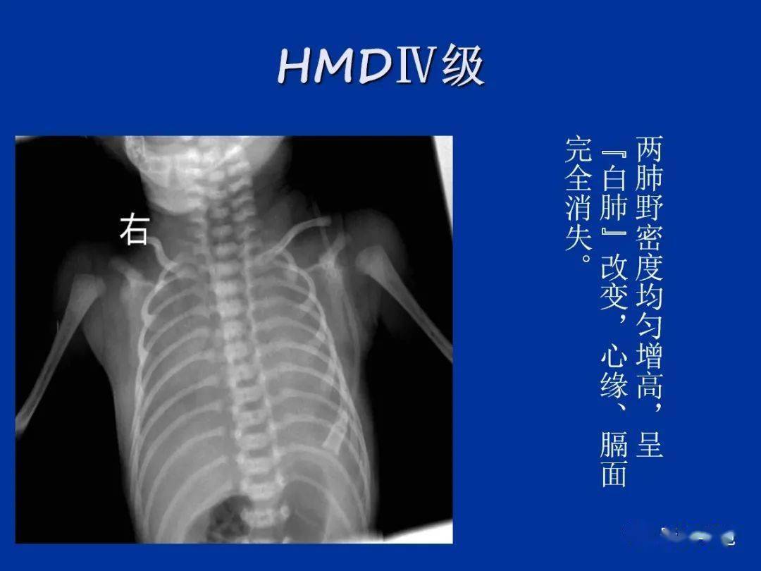 肺小叶、肺间质解剖与病变的HRCT诊断_手机搜狐网