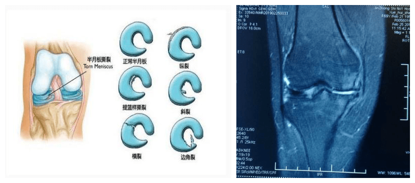 膝关节系列之——你的关节上锁了吗?