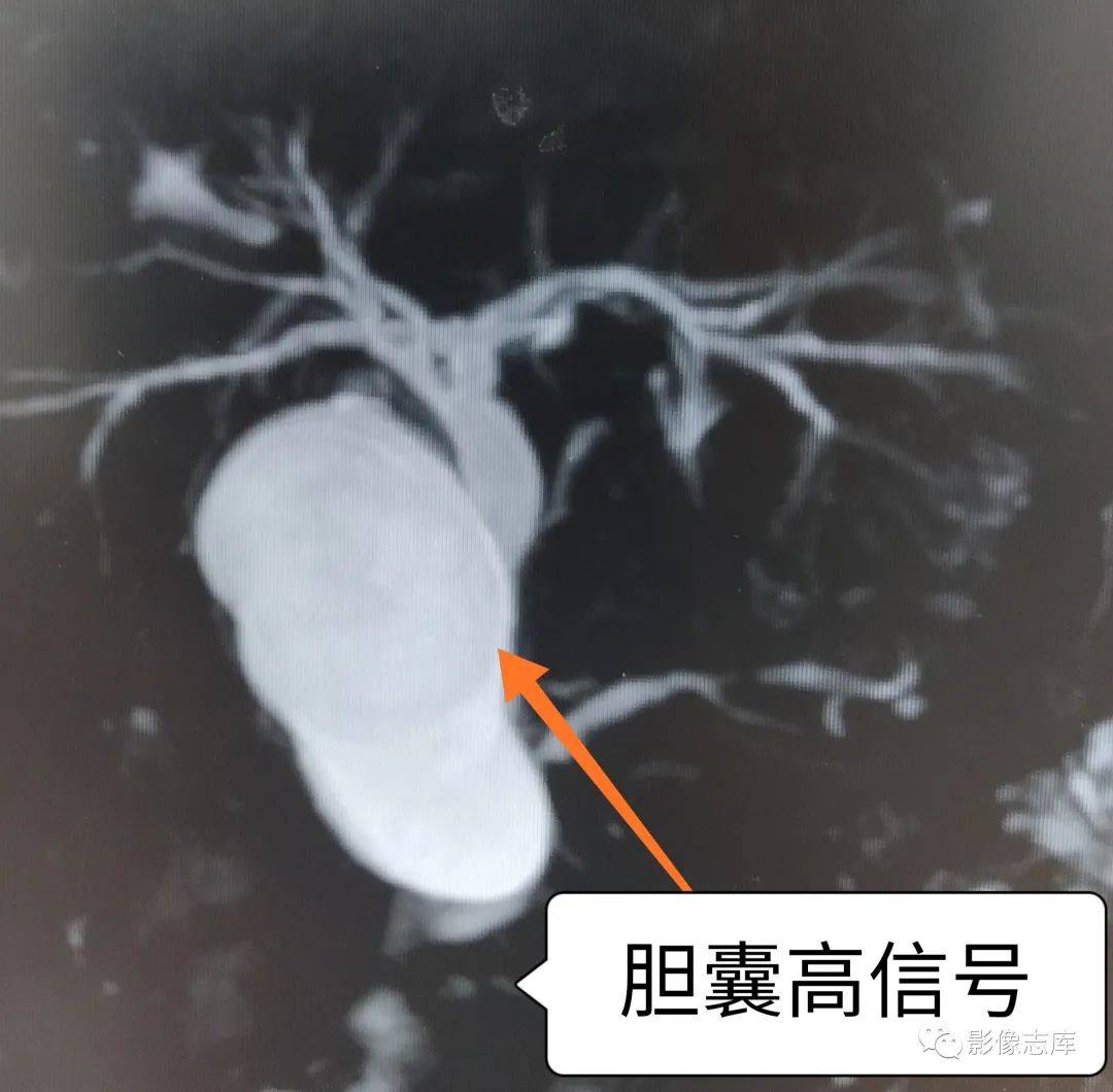 mrcp胆道水成像,为什么胆囊不显示?