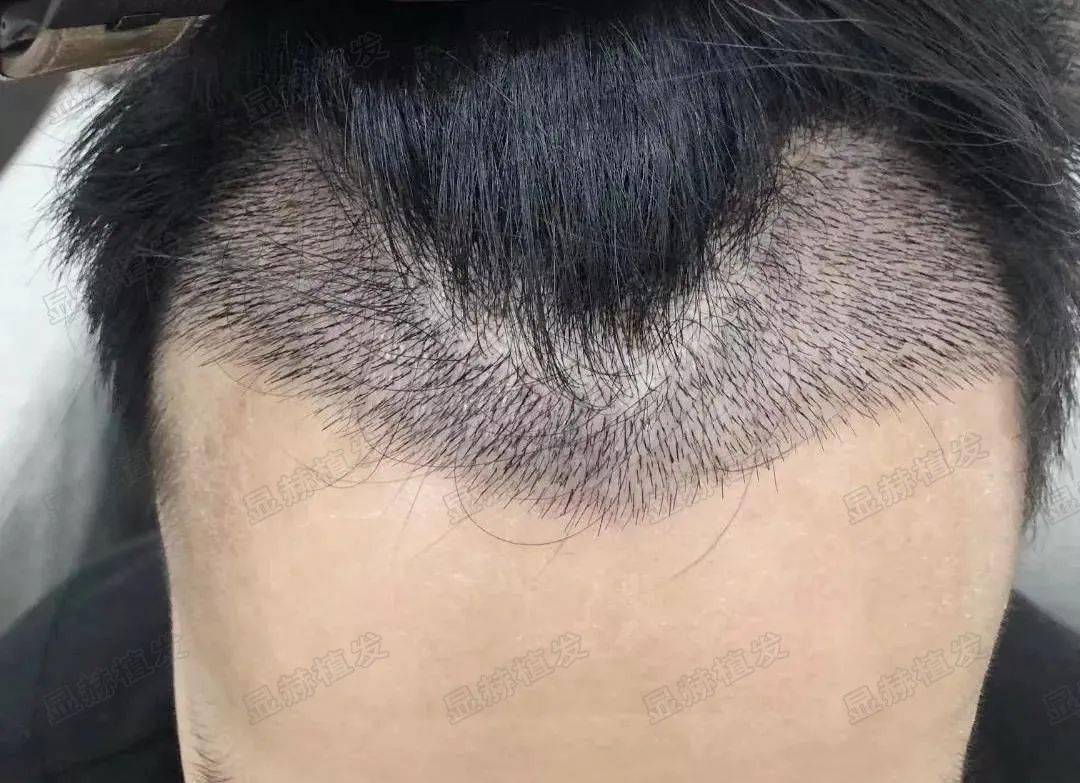 植发10天左右种植的头发根根分明,只需等待头发正常生长, 植发一年才