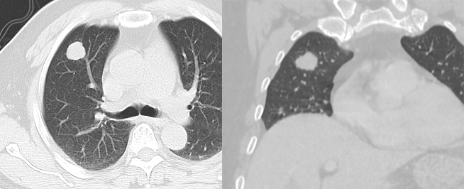 肺转移瘤 vs 十种不典型 ct 表现