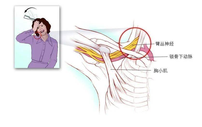 【神经损伤】胸廓出口综合征