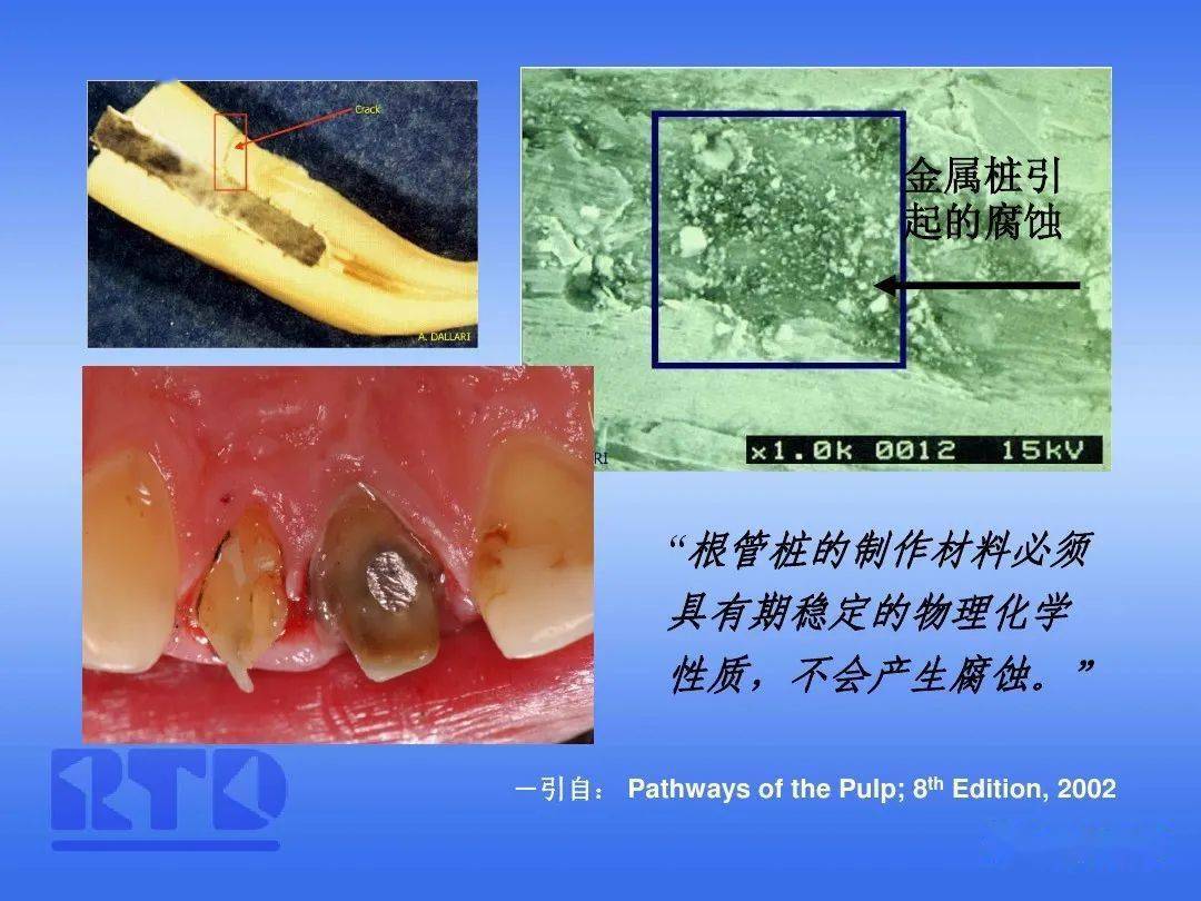 纤维桩技术及其在临床的应用