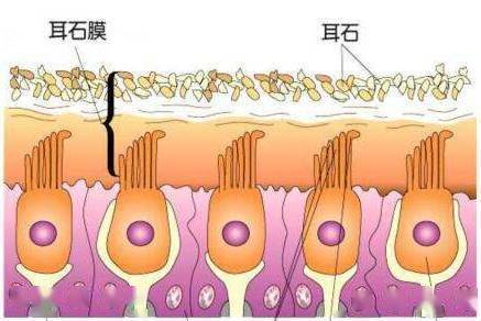 如果由于某些病理因素导致耳石脱落,耳石碎片进入到半规管中,脱落的