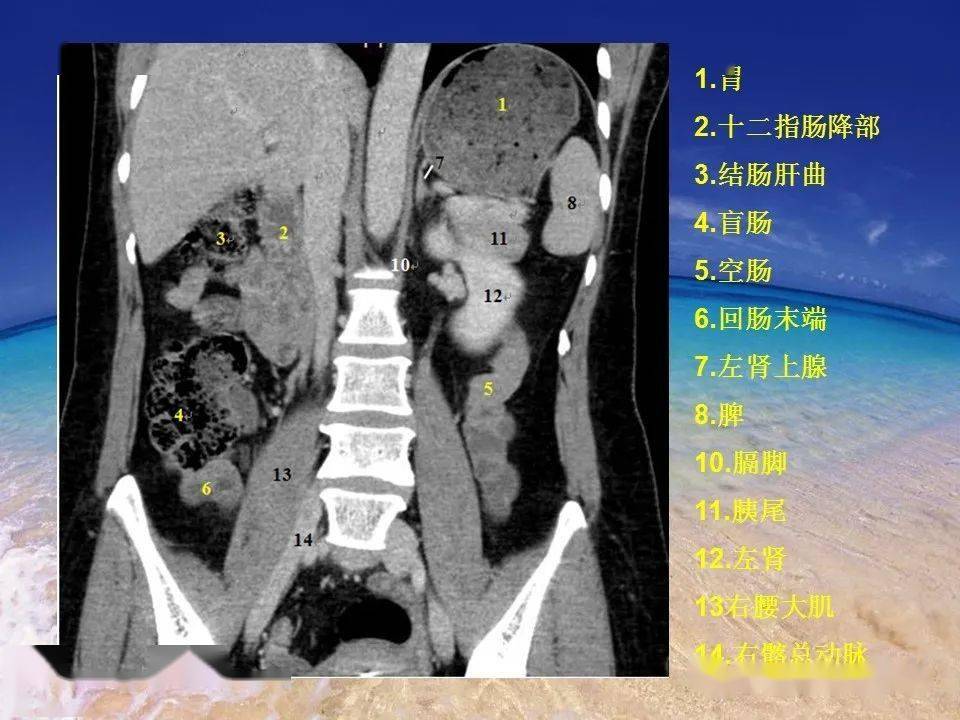 消化道穿孔的ct诊断